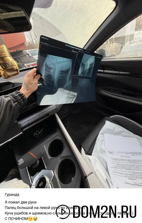 Снимок рёбер Никиты Гуранда