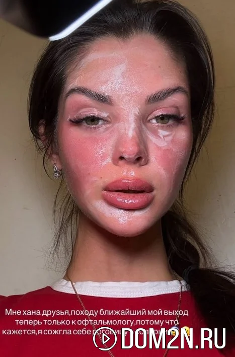 Анна Самонина после ожога в солярии